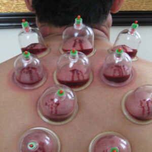 হিজামা প্রতি পয়েন্ট